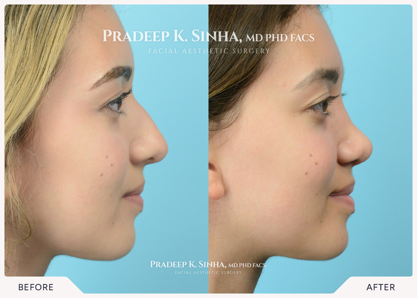 Rhinoplasty