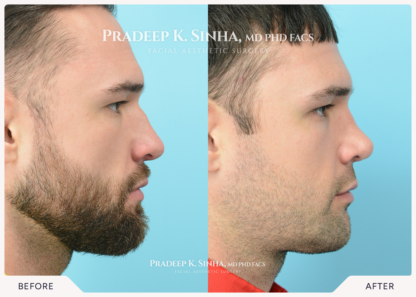 Rhinoplasty