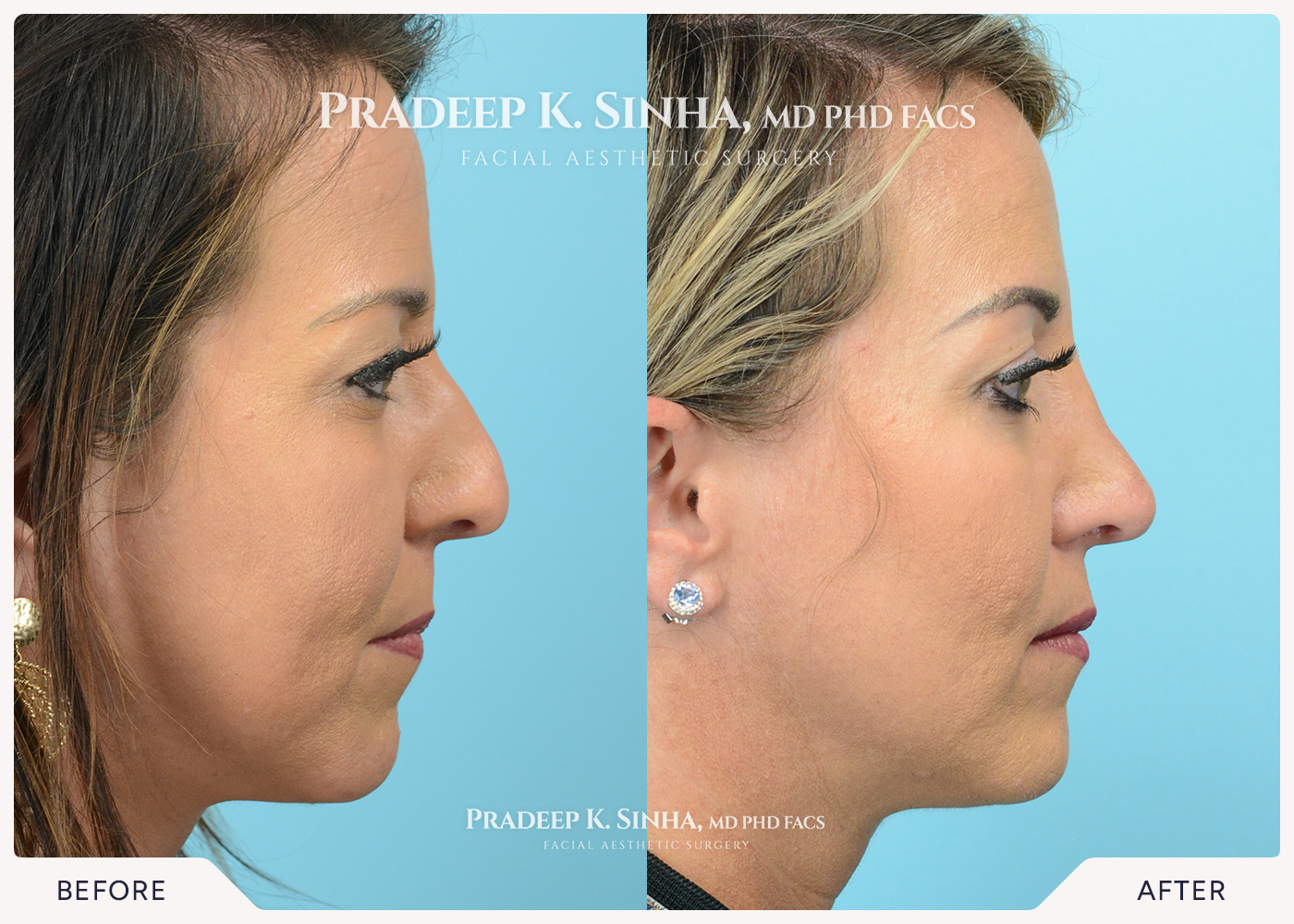 Rhinoplasty