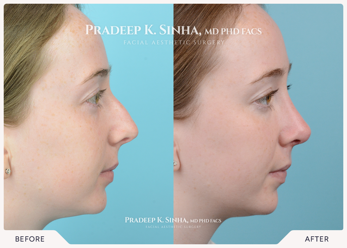 Rhinoplasty
