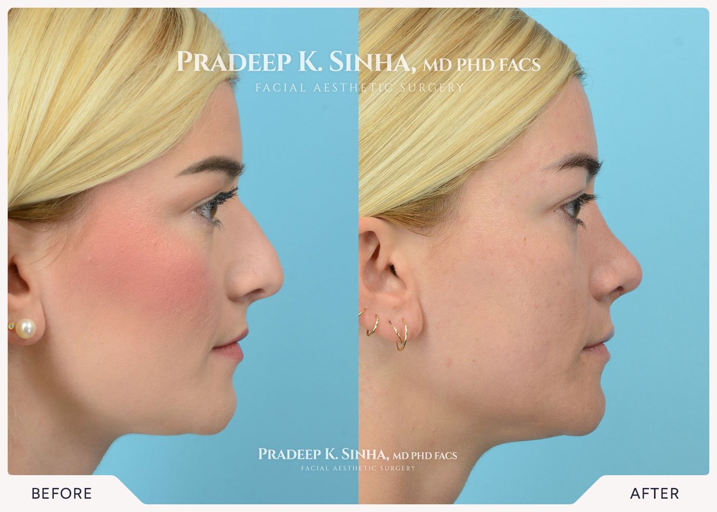 Rhinoplasty