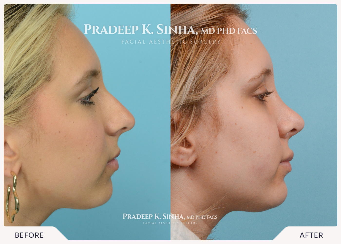 Rhinoplasty
