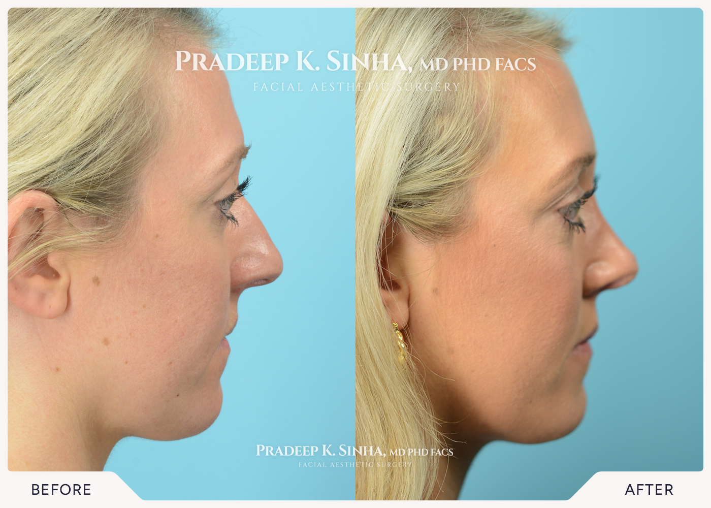 Rhinoplasty