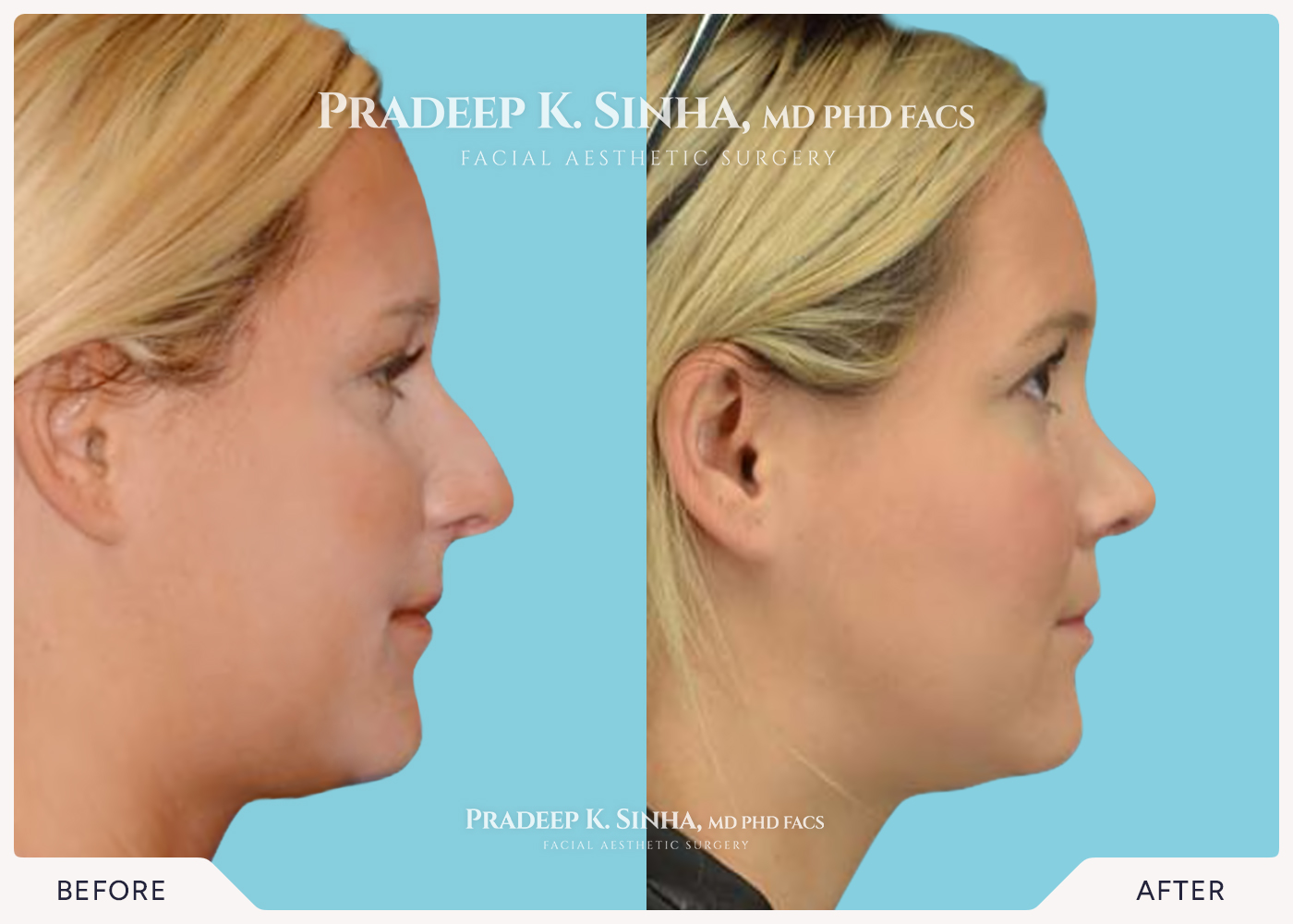 Rhinoplasty