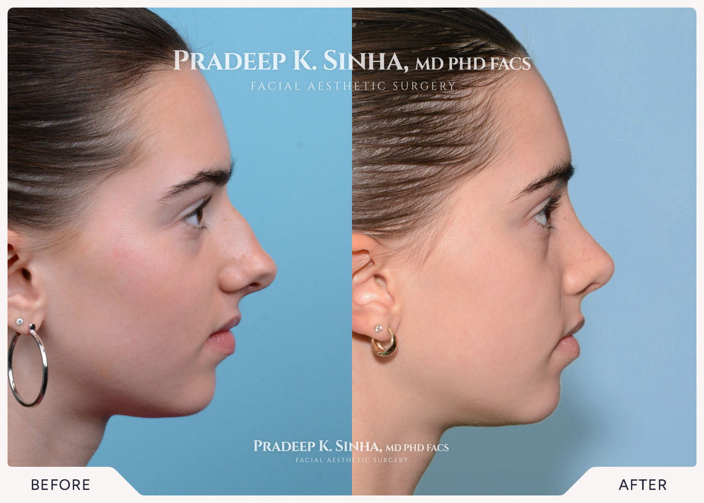 Rhinoplasty