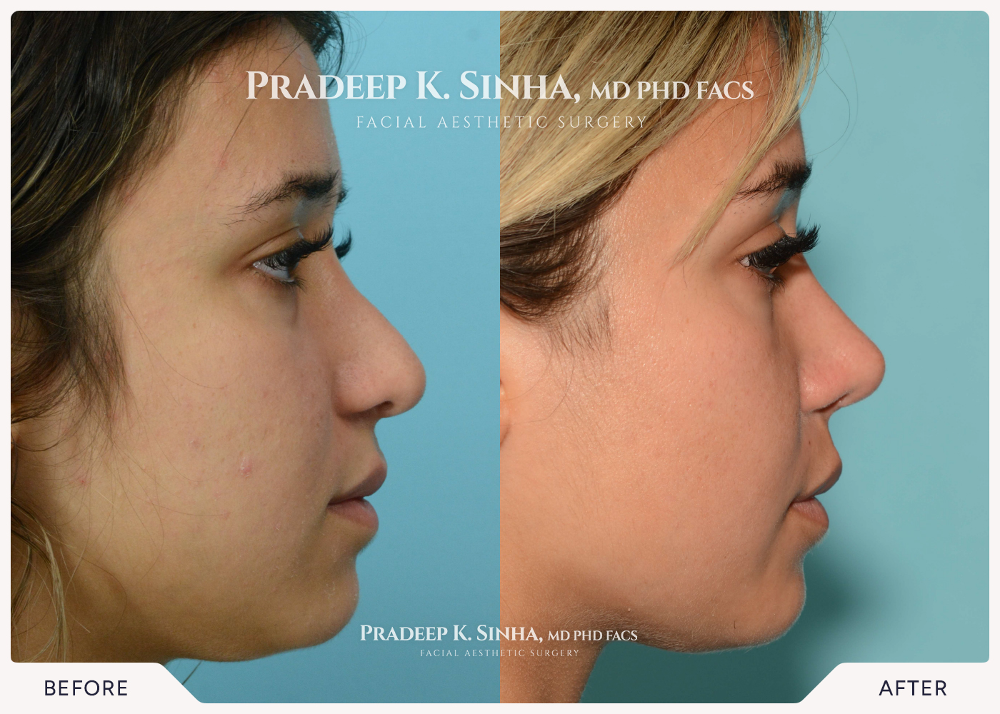 Rhinoplasty